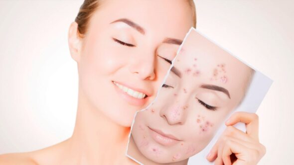 10 dicas para acabar de vez com a acne